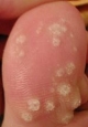 pedicuren, wratbehandeling, steunzolen